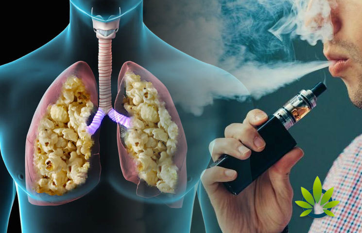 Does vaping lead to popcorn lung disease? Here is what you need to know.